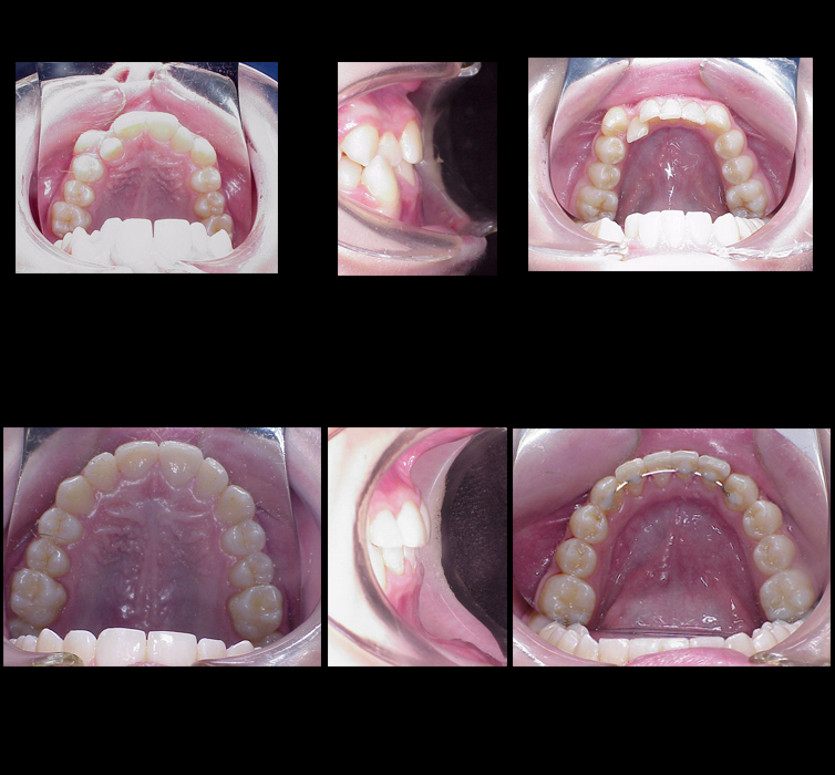 Ortodoncia Antes y Despues