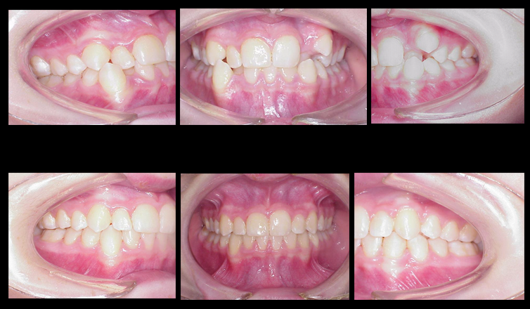 Ortodoncia Antes y Despues