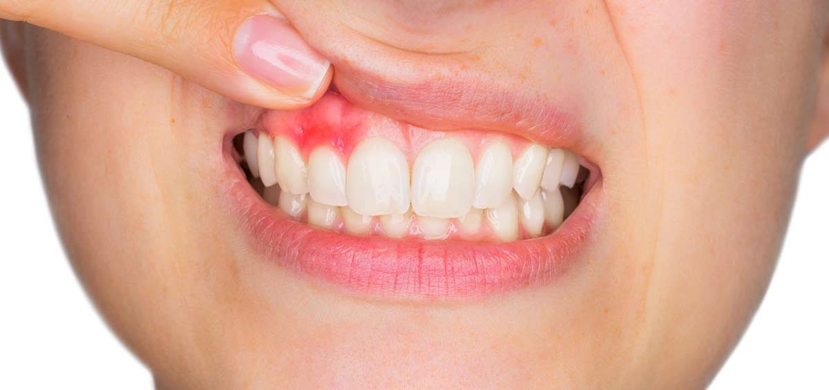 ”Qué indica el color de las encías sobre la salud de tu boca.”